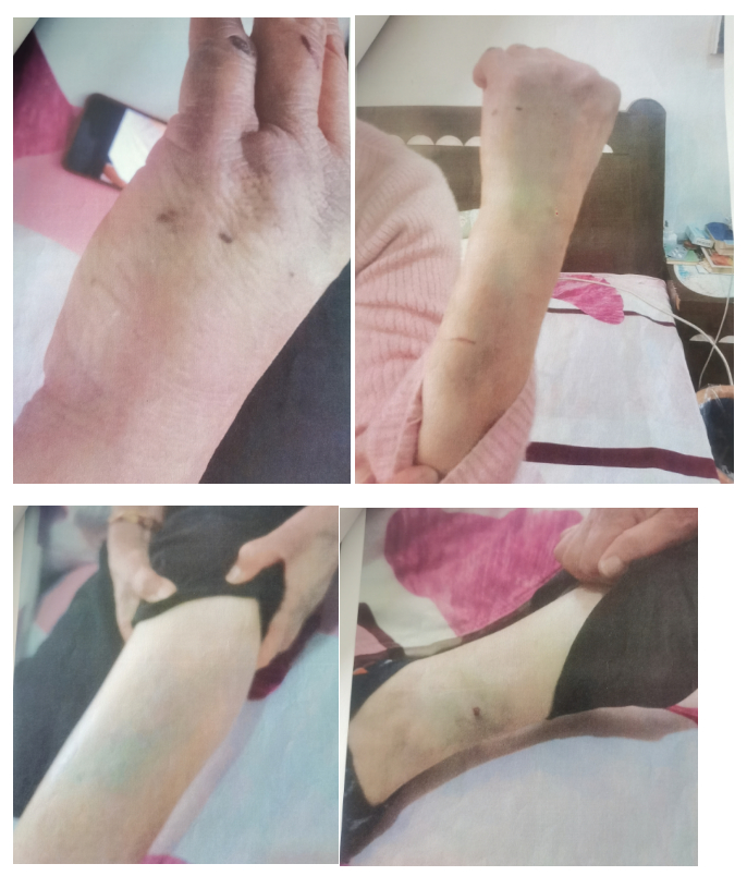 郑女士身上的外伤。