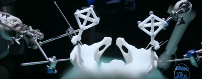 机器人自主操作复杂的骨折手术。图片来源：视频截图 （图文无关）