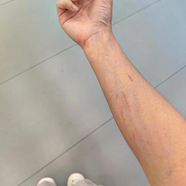 林子的手臂被保温袋边缘划伤。受访者供图