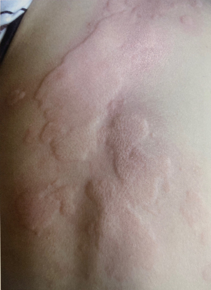 图片来源：《皮肤性病诊断图谱》