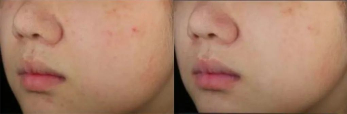 图注：*数据来源于第三方临床功效报告，报告编号HZCPCHE23000159_CN   具体效果因人而异