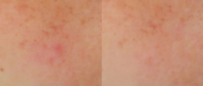 图注：*数据来源于第三方临床功效报告，报告编号HZCPCHE23000159_CN   具体效果因人而异