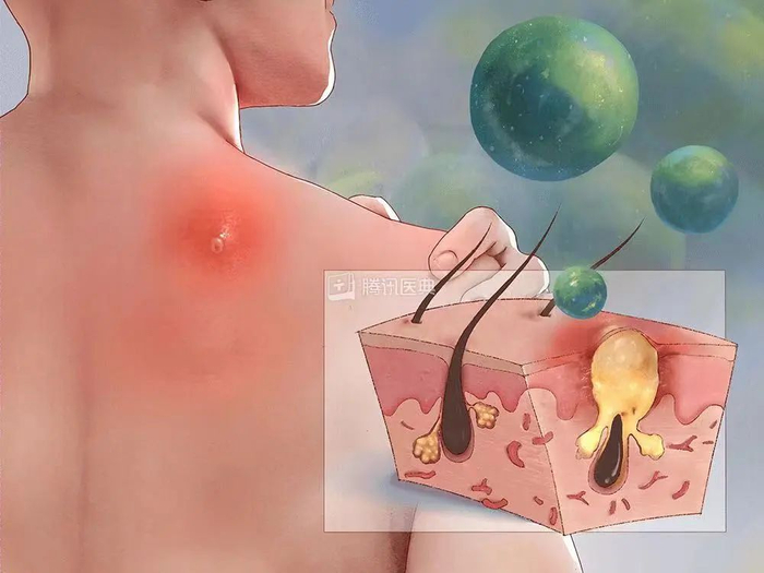 ▲图源：腾讯医典
