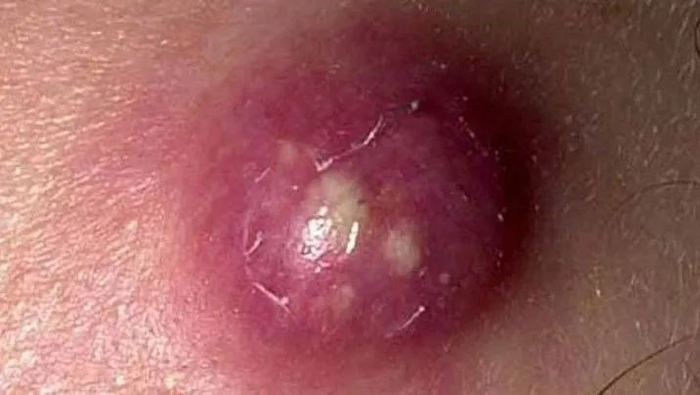 ▲图源：典型的火疖子（引自参考资料）