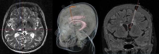 手术计划及术后效果图