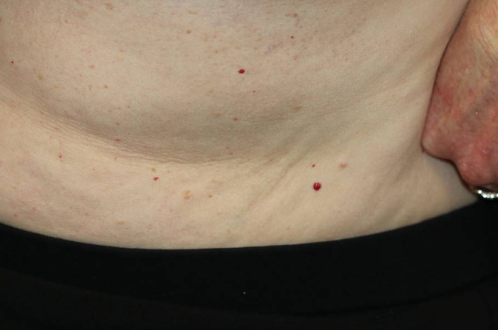 典型的红痣 图片来源：参考资料