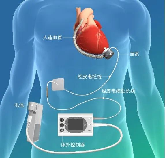 左心室辅助系统BrioVAD™产品示意图
