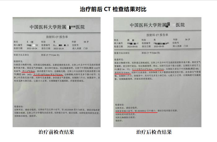 知名肿瘤专家张文彭医生擅用菌药抗肿瘤 磨玻璃肺结节20天消失