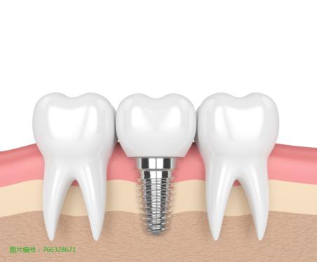 种植牙