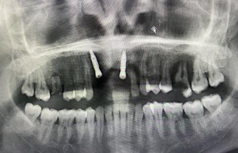 （植入牙根后的影像）
