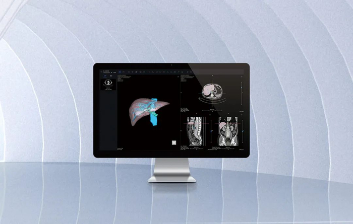 AI辅助肝脏CT影像处理软件