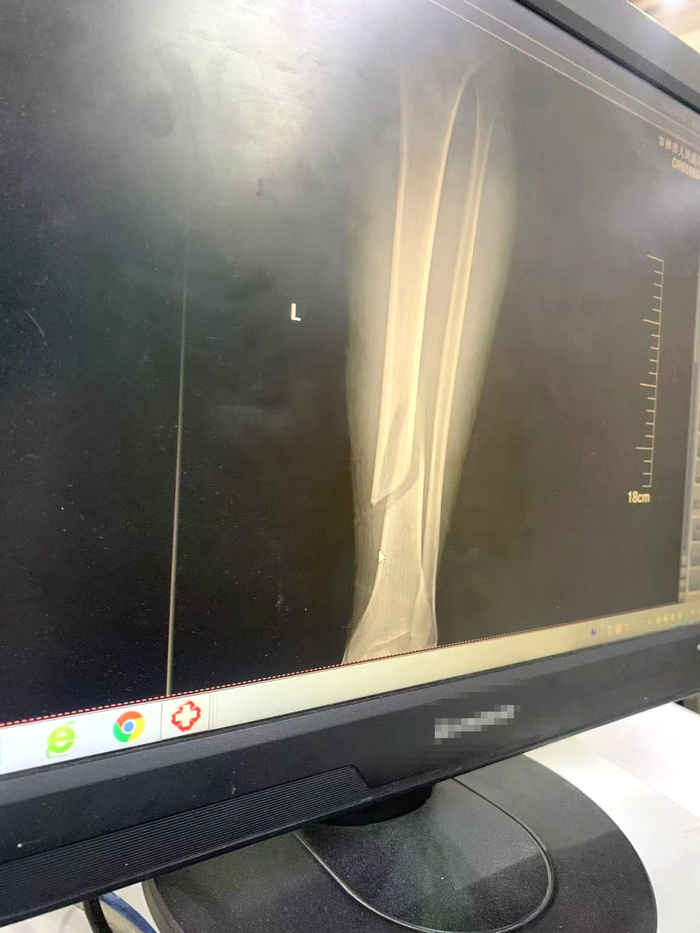 赵琦的左腿骨折。消费者供图