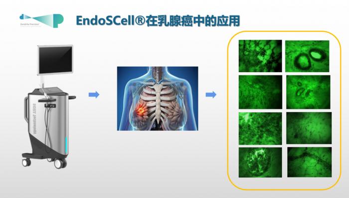 图:EndoSCell®在乳腺癌中的应用