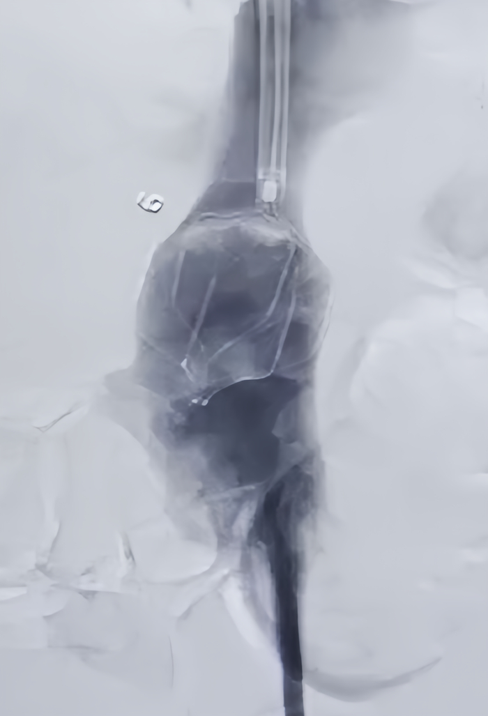 ▲造影血栓保护装置拦截到血栓
