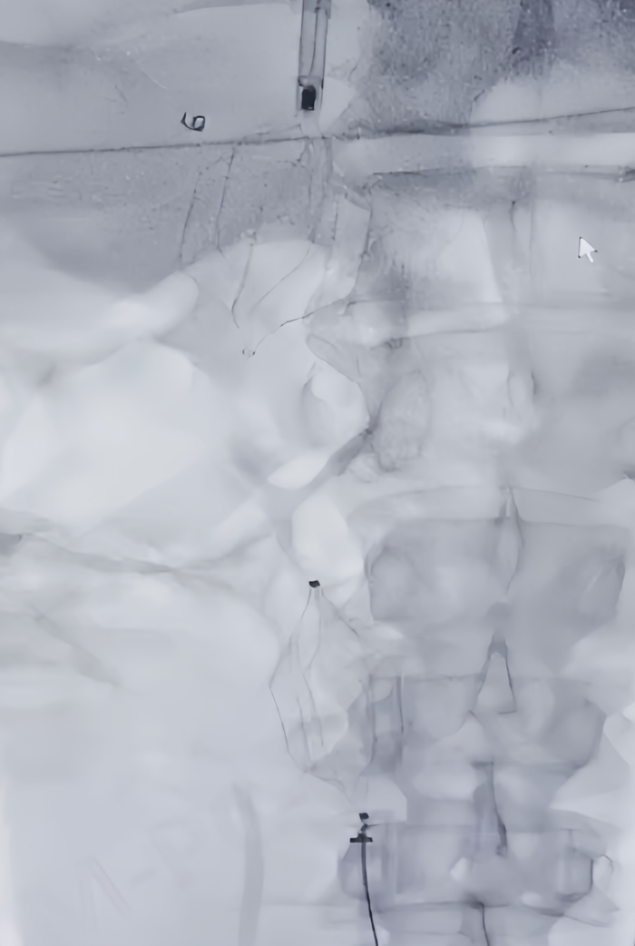 ▲术中血栓保护