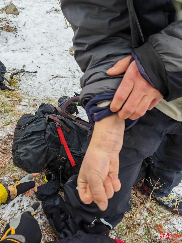 ▲“秦岭牛马队”队员受伤最终导致手部粉碎性骨折