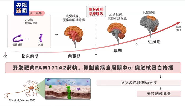 复旦大学附属华山医院郁金泰团队发现了帕金森病全新治疗靶点FAM171A2。央视视频截图