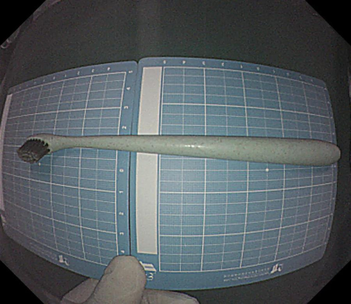 图：胃中取出的牙刷