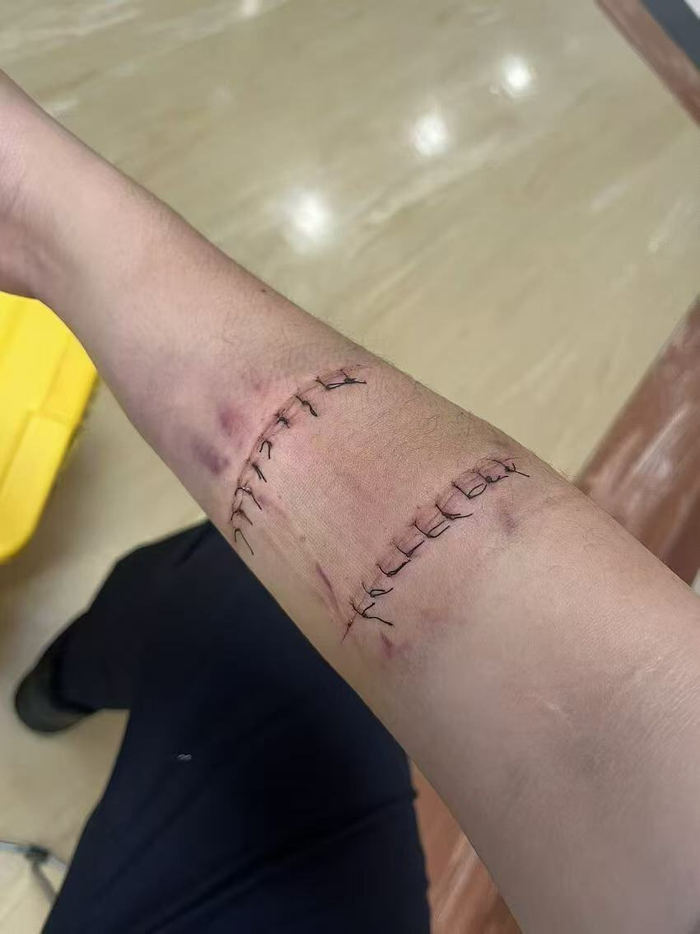 图为杨建明受伤后对伤口进行缝合