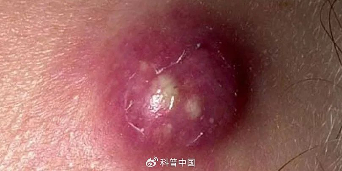图1. 典型的火疖子（引自参考资料）