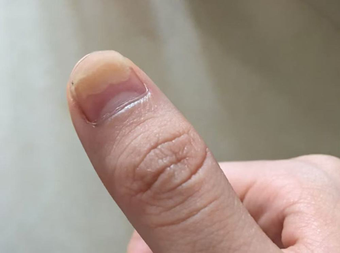 消费者美甲后出现指甲问题。（受访对象供图）