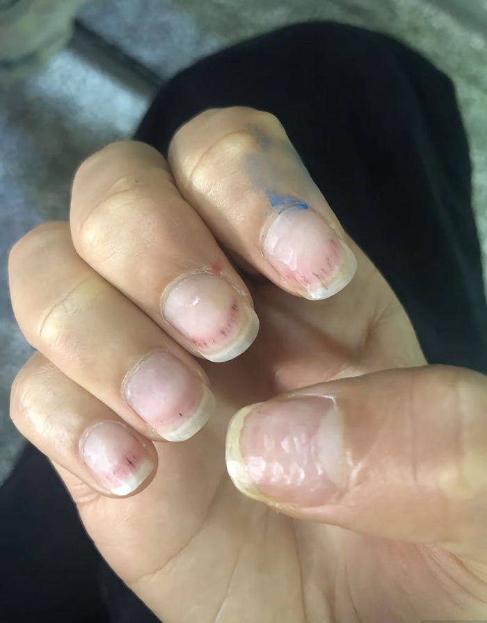 消费者美甲后指甲受损。（受访对象供图）