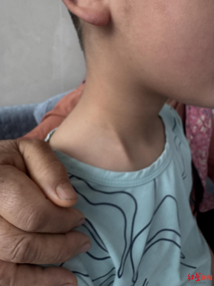 ▲赵平安体内的导流管