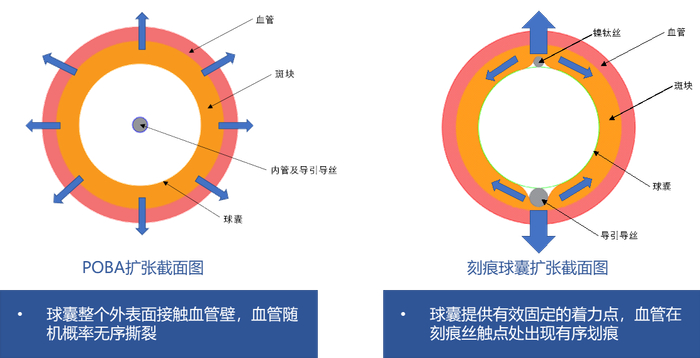 先瑞达外周刻痕球囊扩张导管E-Peridge 获NMPA批准上市|血管|石膏|元件|斑块|股动脉_新浪新闻