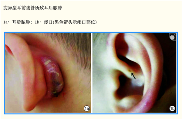 变异型耳前瘘管导致的耳后脓肿。图源参考文献3