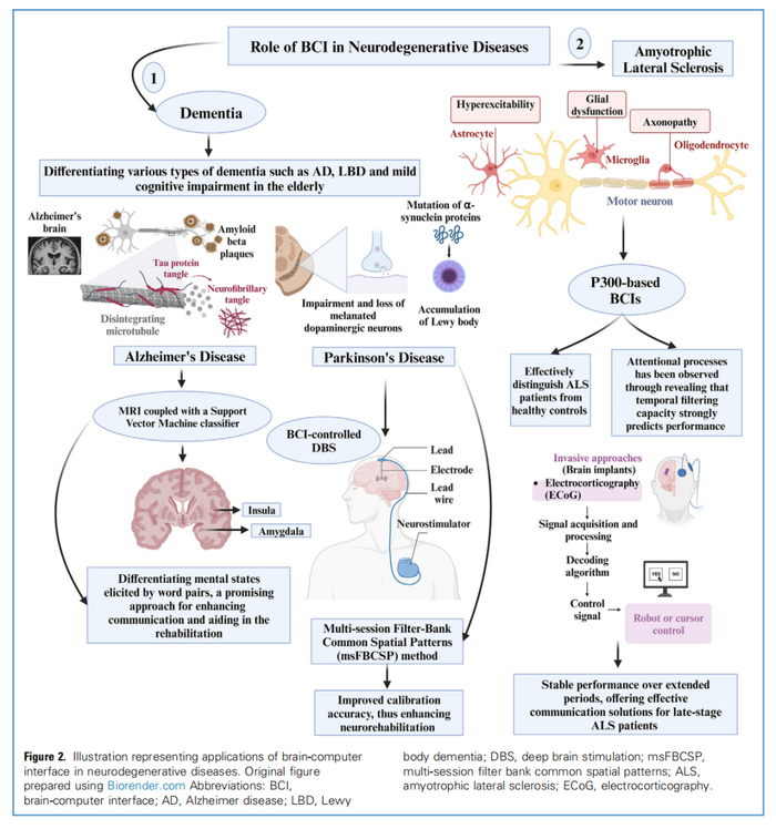 △此图概述了BCI 技术在神经退行性疾病中的应用
