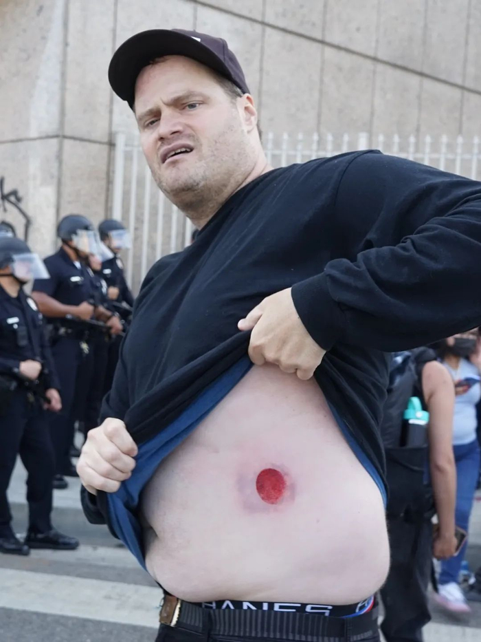 6月8日，在美国加利福尼亚州洛杉矶市中心，一名抗议者展示遭警方枪械击中后留下的伤痕。新华社发（邱晨摄）