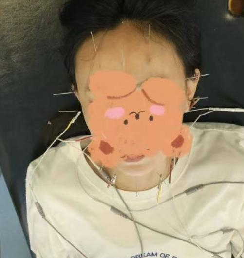▲郭女士扎银针治疗 受访者供图
