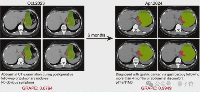 △AI提前6个月识别出胃癌