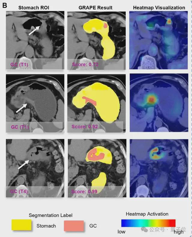 △AI能识别各个阶段的胃癌