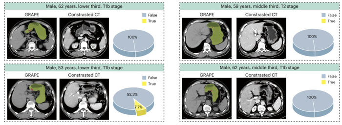 GRAPE 模型与增强 CT 对胃癌早期患者（ T1、T2 期胃癌 ）的检测结果对比。