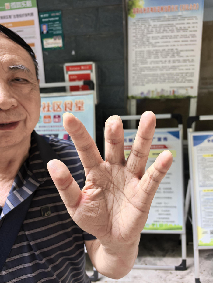 　　陈大爷左手中指短少一节，截面伤疤刚刚愈合。刘铭/摄