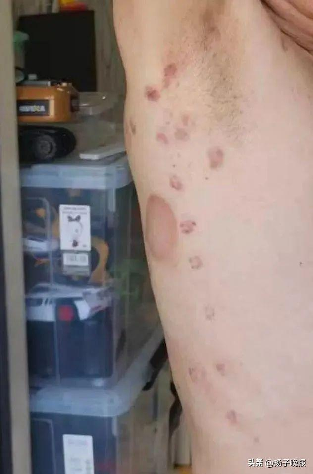 针刺的伤口目前还没有完全愈合。图片来源/受访者供图