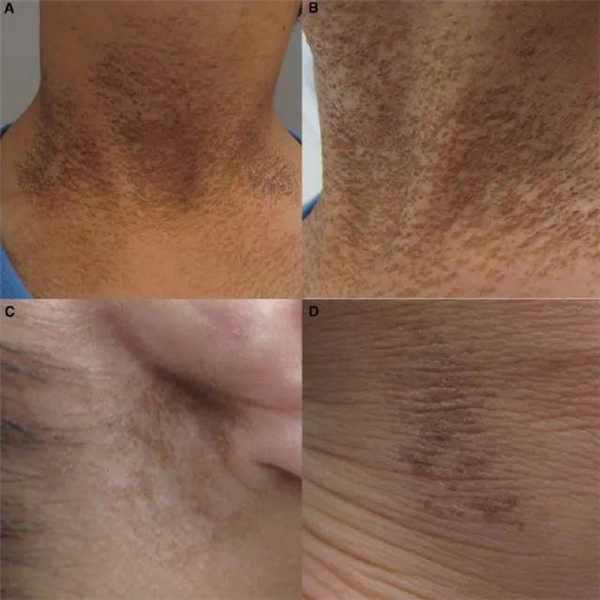 图 6. Terra firma-fome 皮病（来自参考资料）