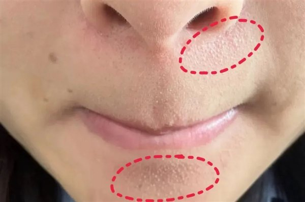 图 1. 小颗粒 来自小红书