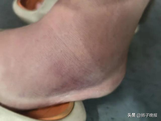 ▲吴峰的脚部受伤。 受访者供图