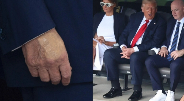 特朗普最近出现手部淤青，脚踝肿胀