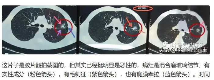 图源：杭州市肿瘤医院胸外科主任叶建明科普文章