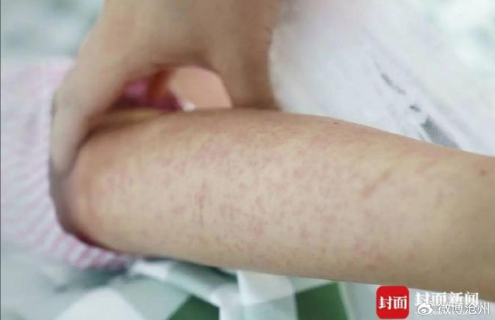 图为皮疹症状