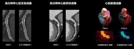 光子计数能谱CT心脏成像。本文图片均为 联影医疗供图
