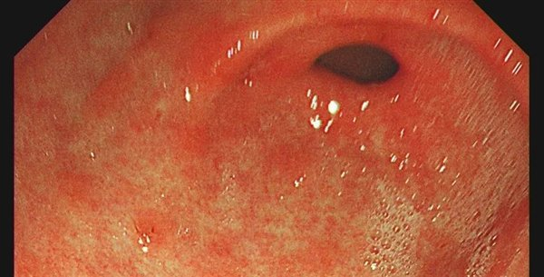 幽门螺旋杆菌感染后的胃，图片来源：作者