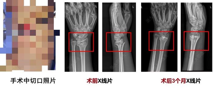 图 3：桡骨远端骨折通过“骨 02”治疗病例