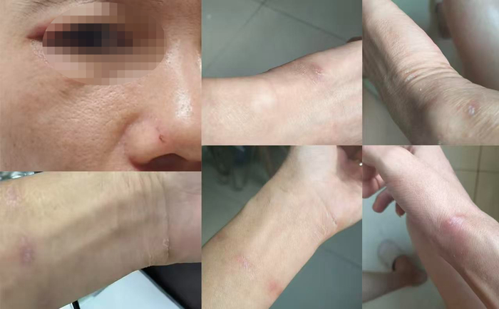 ▲阿東身上的傷痕依舊清晰可見(jiàn)