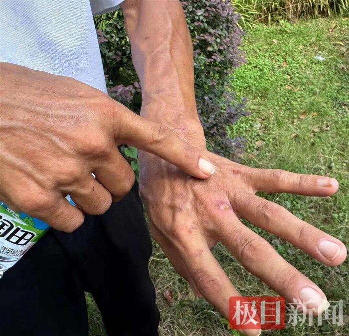 鸡排哥炸鸡排时烫伤留疤的手