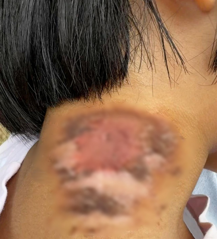 王女士女儿的伤口（图源：受访者提供）