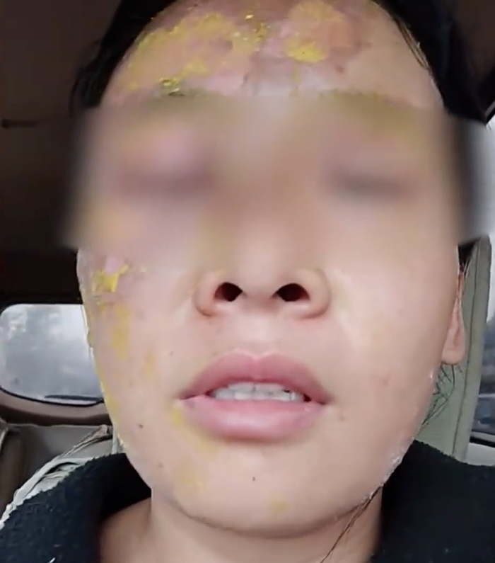 吴女士称她的伤势正在恢复。图源：大象新闻视频截图 